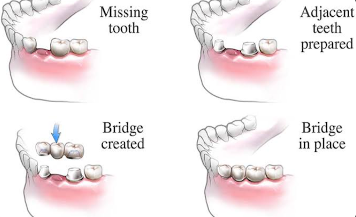 What May Be Involved in Getting a Dental Crown or Bridge: A General Overview